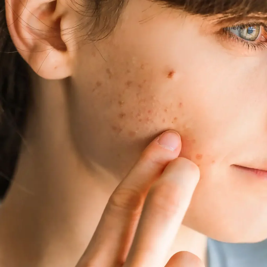 Classical dermatology acne treatment Sendlinger Tor