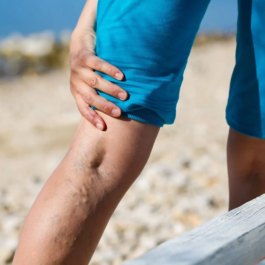 Phlebology Phleobology Sendlinger Tor