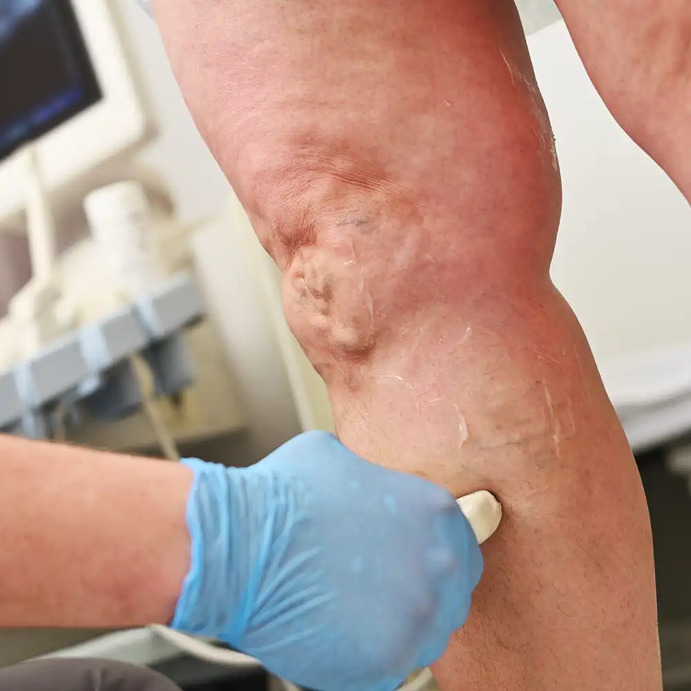 Dermatology Sendlinger Tor Treatments Thrombosis