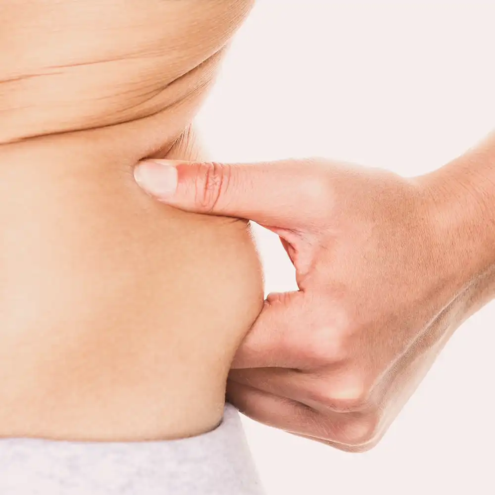 Fat reduction with laser heat Dermatology at Sendlinger Tor Munich