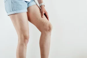 Varicose veins woman legs in denim shorts with vascular stars iso